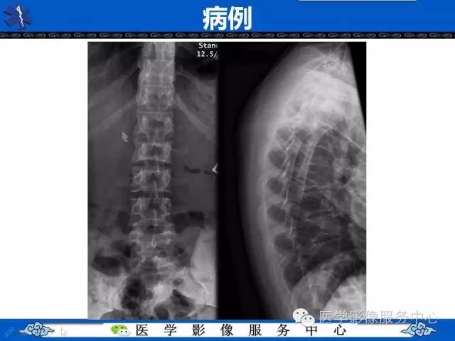 鱼口征的影像学表现，你了解吗？