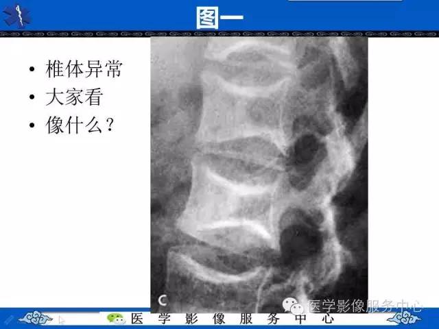 鱼口征的影像学表现，你了解吗？