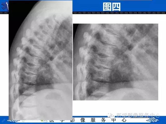 鱼口征的影像学表现，你了解吗？