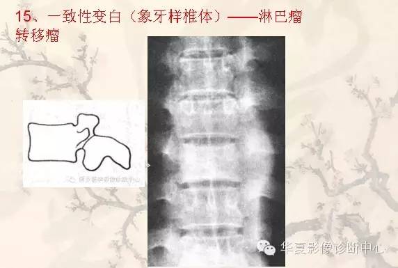 从椎体形态，“巧记”这20种椎体疾病