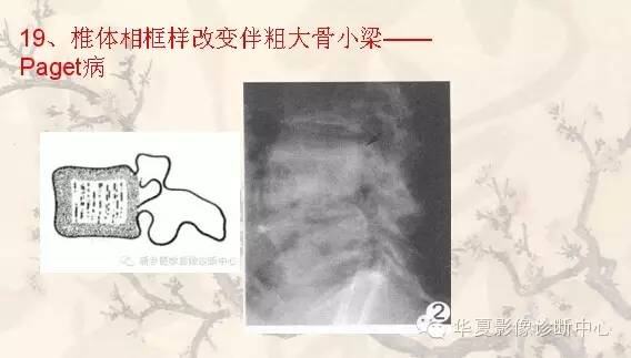 从椎体形态，“巧记”这20种椎体疾病