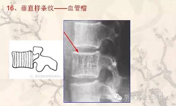 从椎体形态，“巧记”这20种椎体疾病