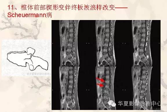 从椎体形态，“巧记”这20种椎体疾病