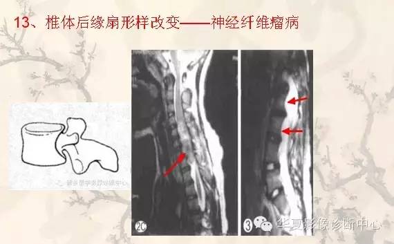 从椎体形态，“巧记”这20种椎体疾病