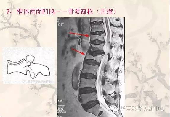 从椎体形态，“巧记”这20种椎体疾病