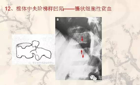 从椎体形态，“巧记”这20种椎体疾病