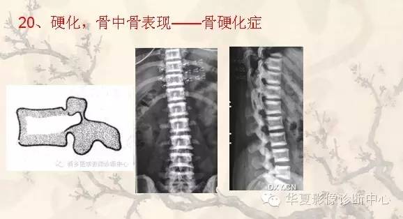 从椎体形态，“巧记”这20种椎体疾病