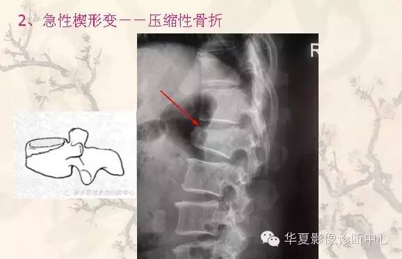 从椎体形态，“巧记”这20种椎体疾病