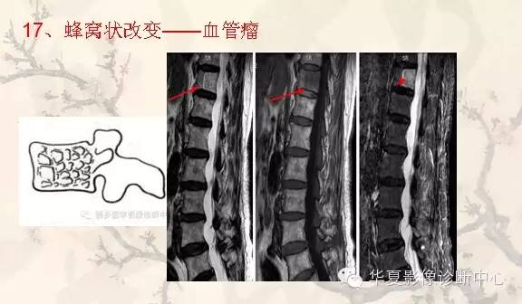 从椎体形态，“巧记”这20种椎体疾病