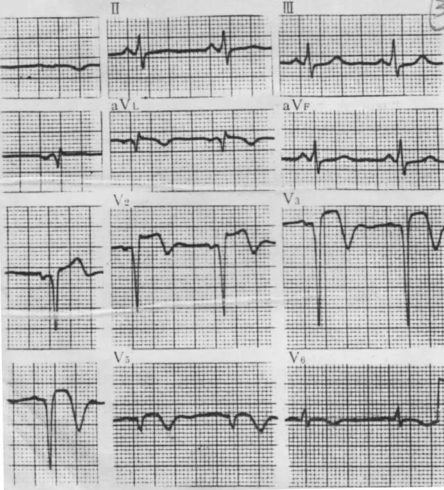 各型冠心病的心电图诊断与鉴别诊断