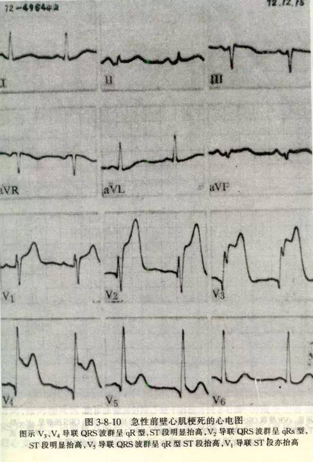 各型冠心病的心电图诊断与鉴别诊断