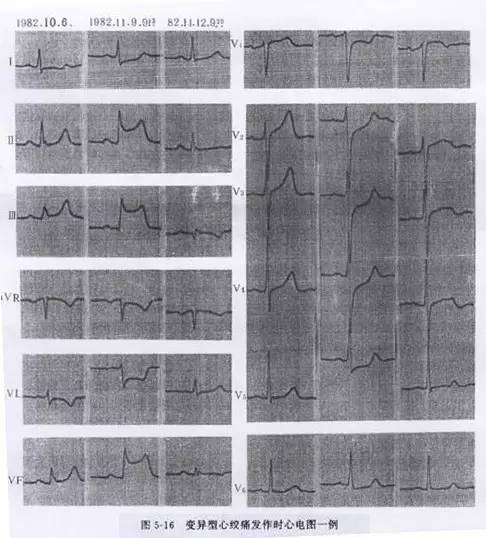 各型冠心病的心电图诊断与鉴别诊断