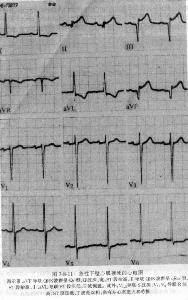 各型冠心病的心电图诊断与鉴别诊断