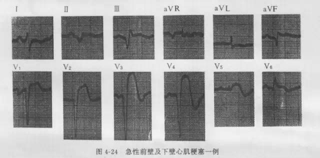 各型冠心病的心电图诊断与鉴别诊断