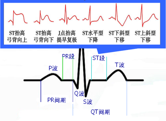 各型冠心病的心电图诊断与鉴别诊断