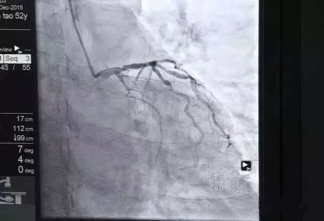 带您亲临冠脉支架介入手术现场