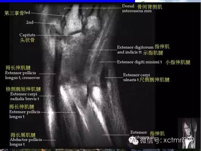 值得收藏！腕关节MR解剖中英对照