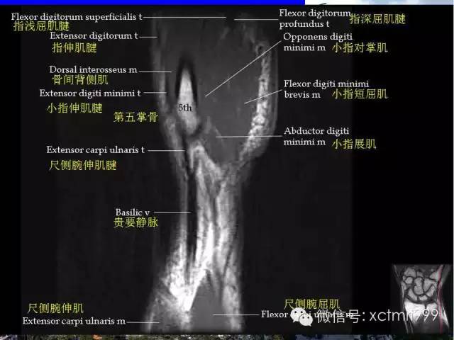 值得收藏！腕关节MR解剖中英对照