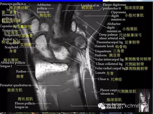 值得收藏！腕关节MR解剖中英对照