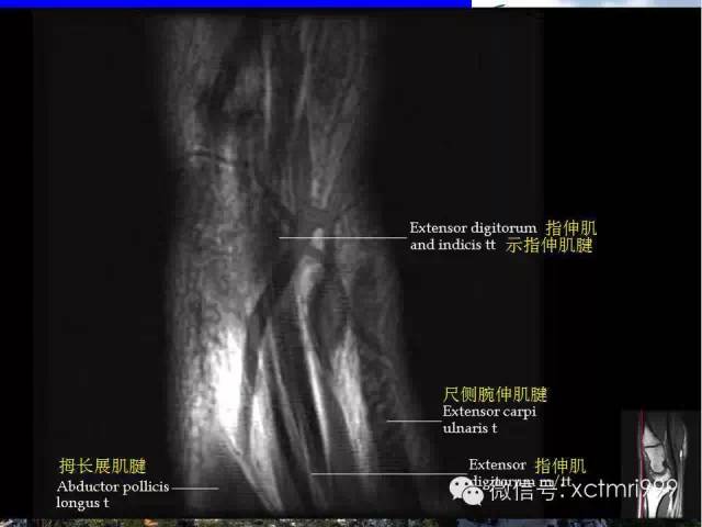 值得收藏！腕关节MR解剖中英对照