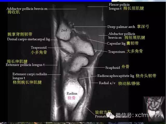 值得收藏！腕关节MR解剖中英对照