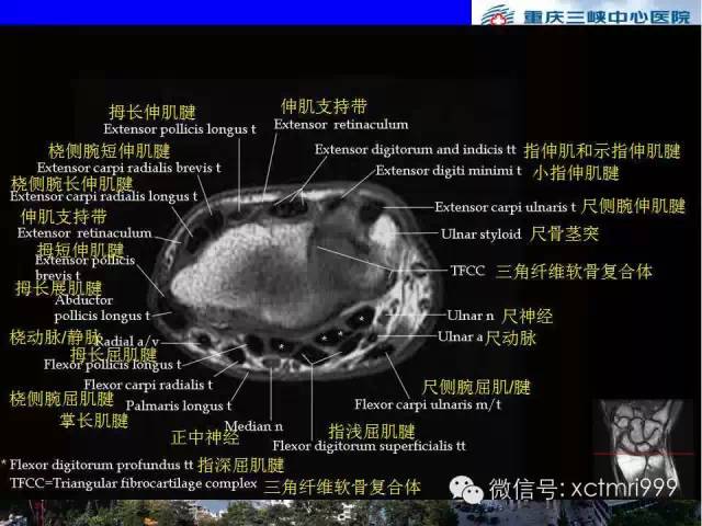 值得收藏！腕关节MR解剖中英对照