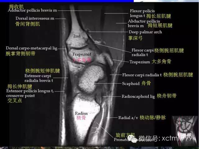 值得收藏！腕关节MR解剖中英对照