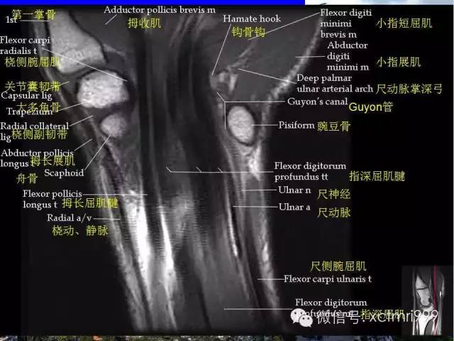 值得收藏！腕关节MR解剖中英对照