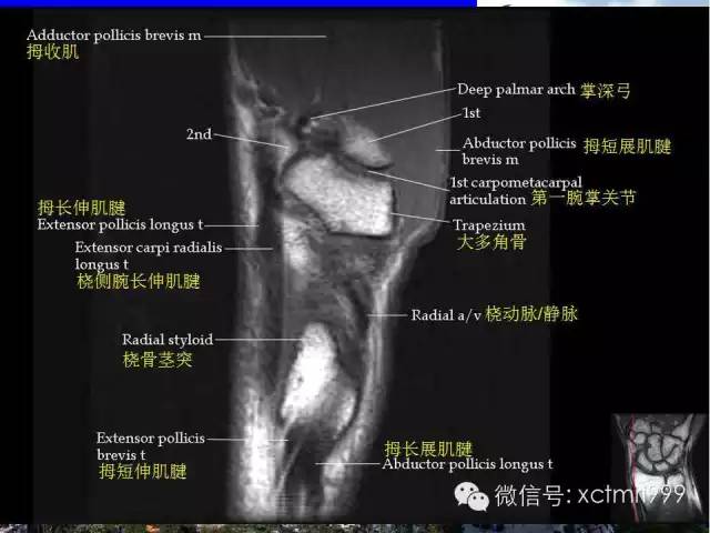 值得收藏！腕关节MR解剖中英对照