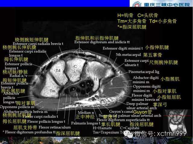 值得收藏！腕关节MR解剖中英对照