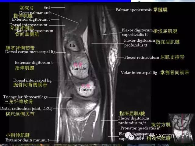 值得收藏！腕关节MR解剖中英对照