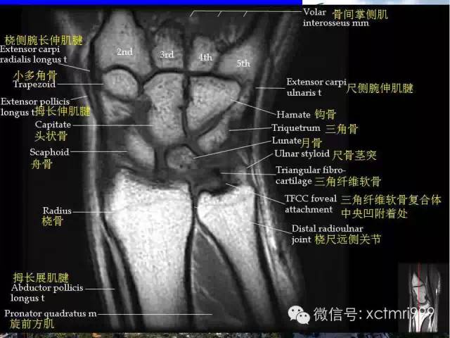 值得收藏！腕关节MR解剖中英对照