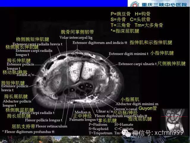 值得收藏！腕关节MR解剖中英对照