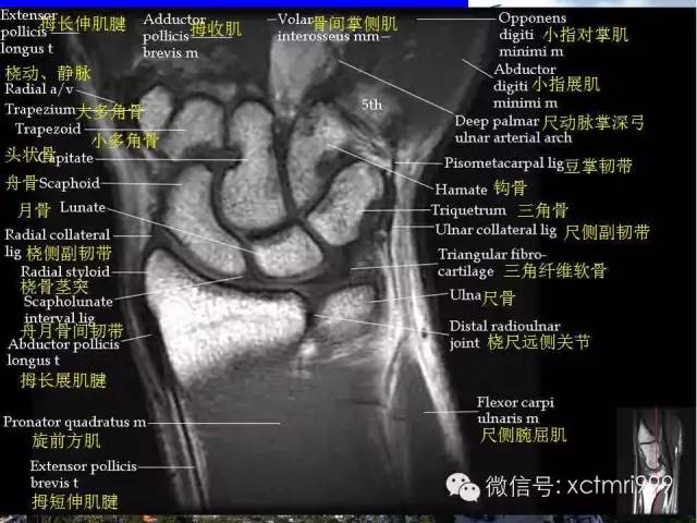 值得收藏！腕关节MR解剖中英对照