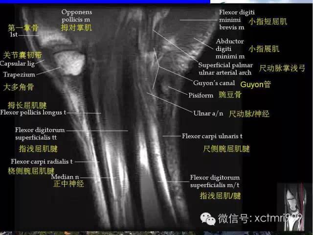 值得收藏！腕关节MR解剖中英对照