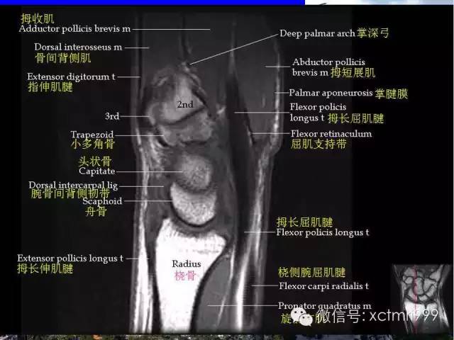 值得收藏！腕关节MR解剖中英对照