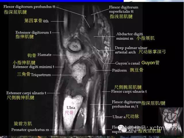 值得收藏！腕关节MR解剖中英对照