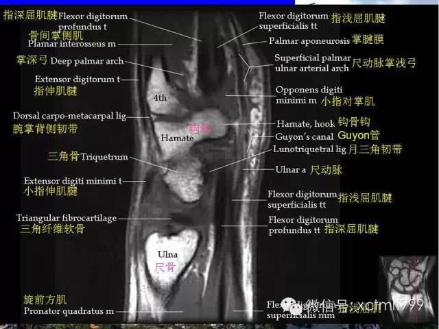 值得收藏！腕关节MR解剖中英对照