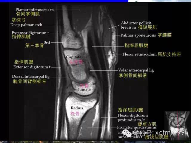 值得收藏！腕关节MR解剖中英对照