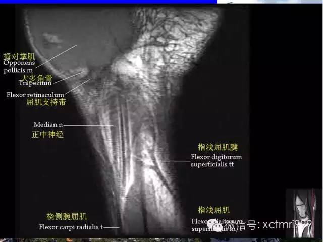 值得收藏！腕关节MR解剖中英对照