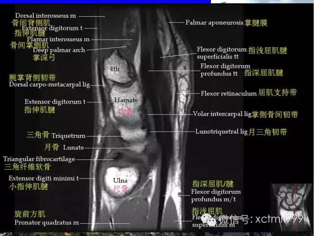 值得收藏！腕关节MR解剖中英对照