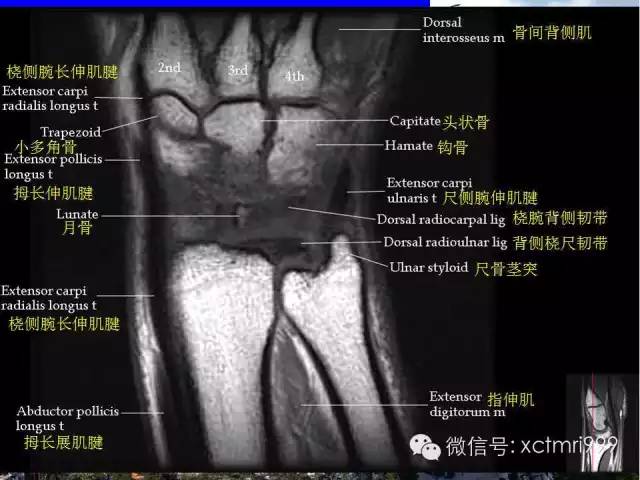 值得收藏！腕关节MR解剖中英对照