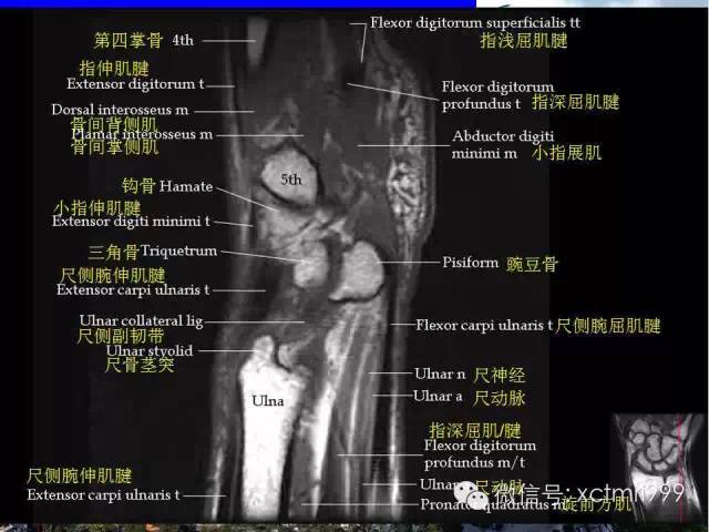 值得收藏！腕关节MR解剖中英对照