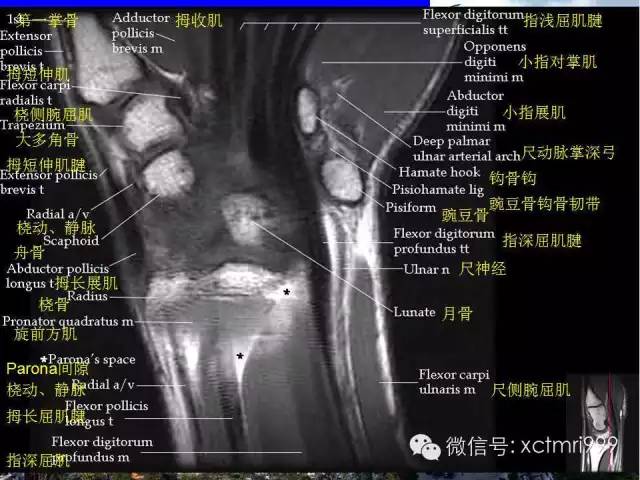 值得收藏！腕关节MR解剖中英对照