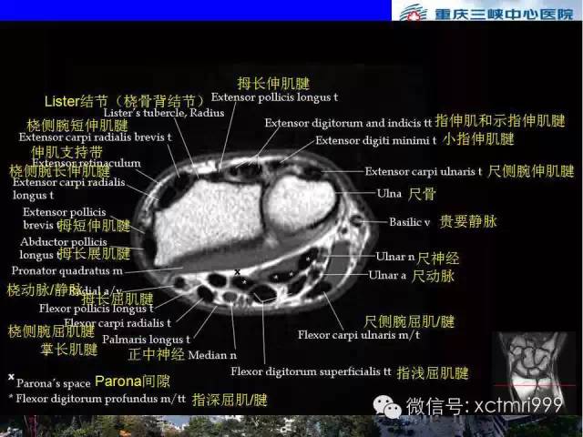 值得收藏！腕关节MR解剖中英对照