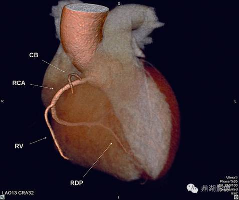 一篇文章解决冠脉CTA，赶紧收藏！