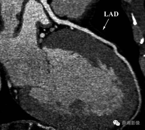 一篇文章解决冠脉CTA，赶紧收藏！