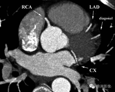 一篇文章解决冠脉CTA，赶紧收藏！