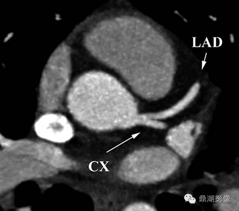 一篇文章解决冠脉CTA，赶紧收藏！