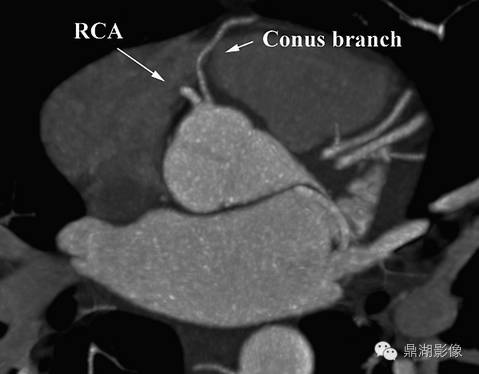 一篇文章解决冠脉CTA，赶紧收藏！